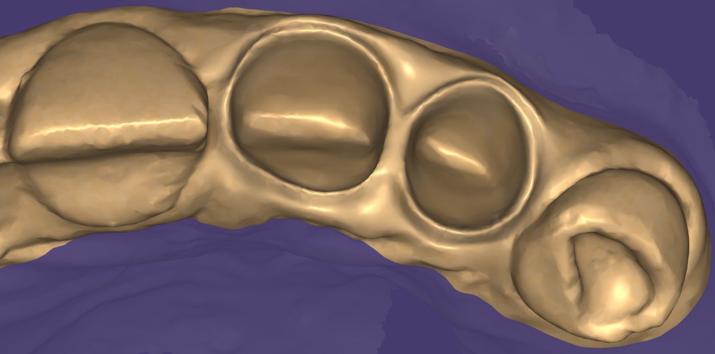 Processed dental scan — clean model with the cervical junction revealed
