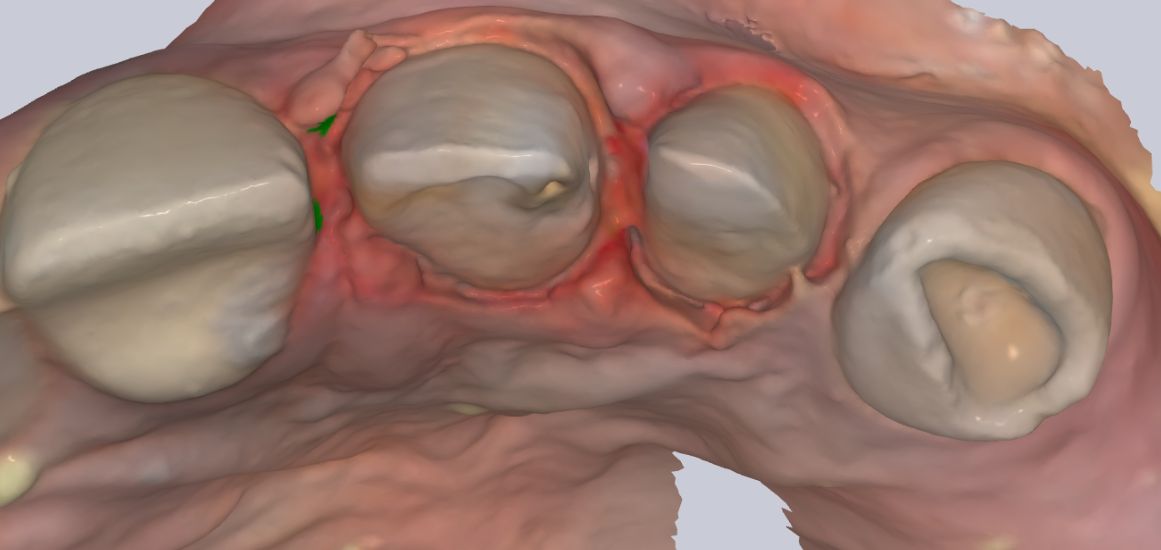 Raw dental scan with noise and soft-tissue artefacts